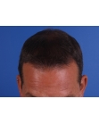 After Hair Transplant&nbsp;2 Sessions (Areas)